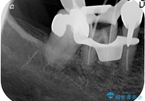 大臼歯 再根管治療の治療中