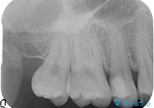 奥歯の虫歯 セラミックインレーにの治療前