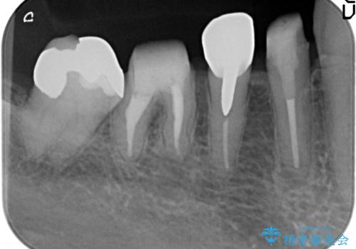 大臼歯　再根管治療の治療後