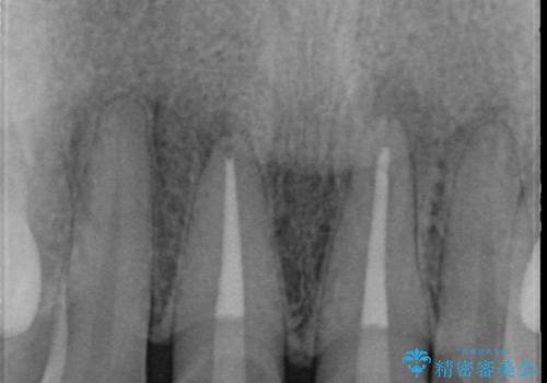 前歯の変色 根管治療と高品質セラミック歯科治療の治療中