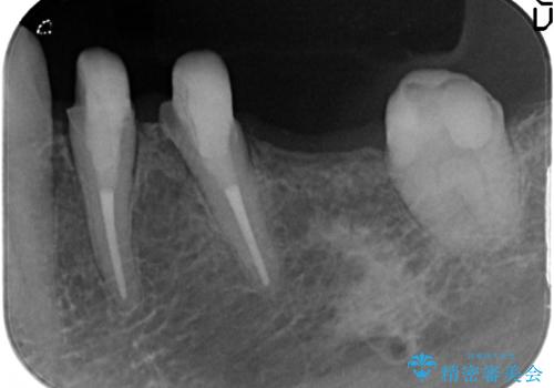 [奥歯のセラミック治療] 銀歯のブリッジを白くの治療中