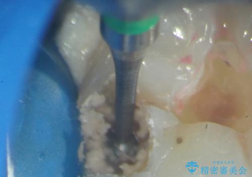 マイクロスコープ下で行う精密虫歯治療の治療前