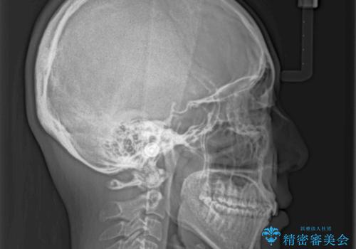 ディープバイトと前歯のデコボコを治したい インビザラインによる矯正治療の治療前