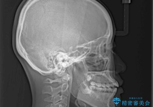 話しにくいオープンバイト インビザラインによる矯正治療の治療前