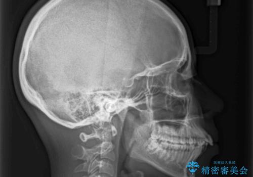 口が閉じられない 抜歯矯正で口元をスッキリとの治療前