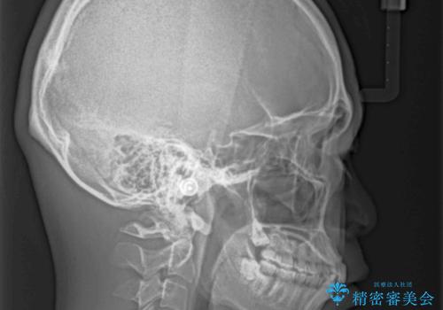 深い咬み合わせと前歯のデコボコの改善 インビザラインによる矯正治療の治療前