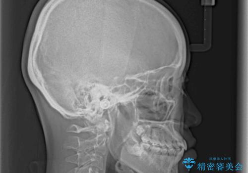 話しにくいオープンバイト インビザラインによる矯正治療の治療後