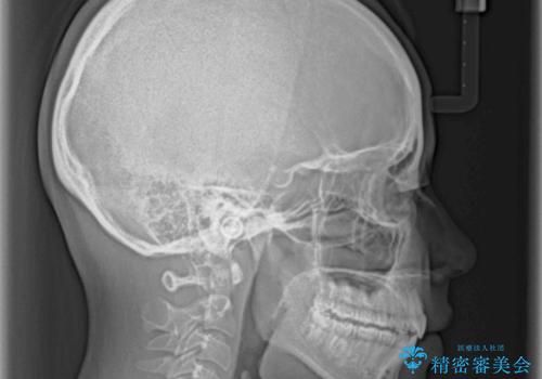 口が閉じられない 抜歯矯正で口元をスッキリとの治療後