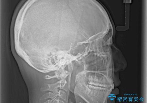 ディープバイトと前歯のデコボコを治したい インビザラインによる矯正治療の治療後