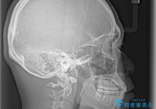 深い咬み合わせと前歯のデコボコの改善 インビザラインによる矯正治療の治療後