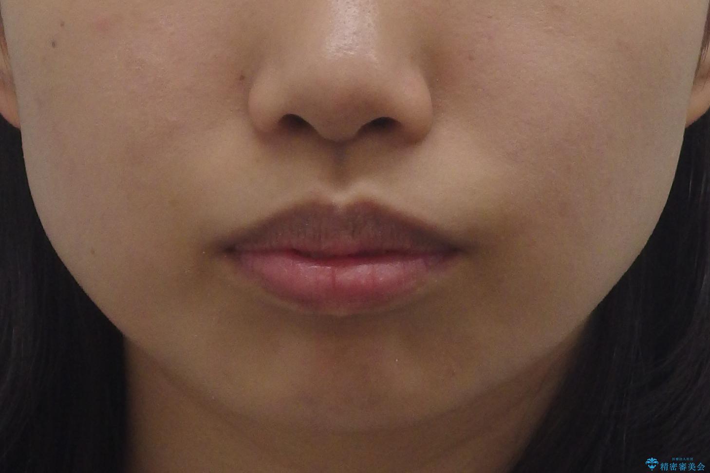 Eラインを整える治療 前歯を引っ込めますの治療前(顔貌)