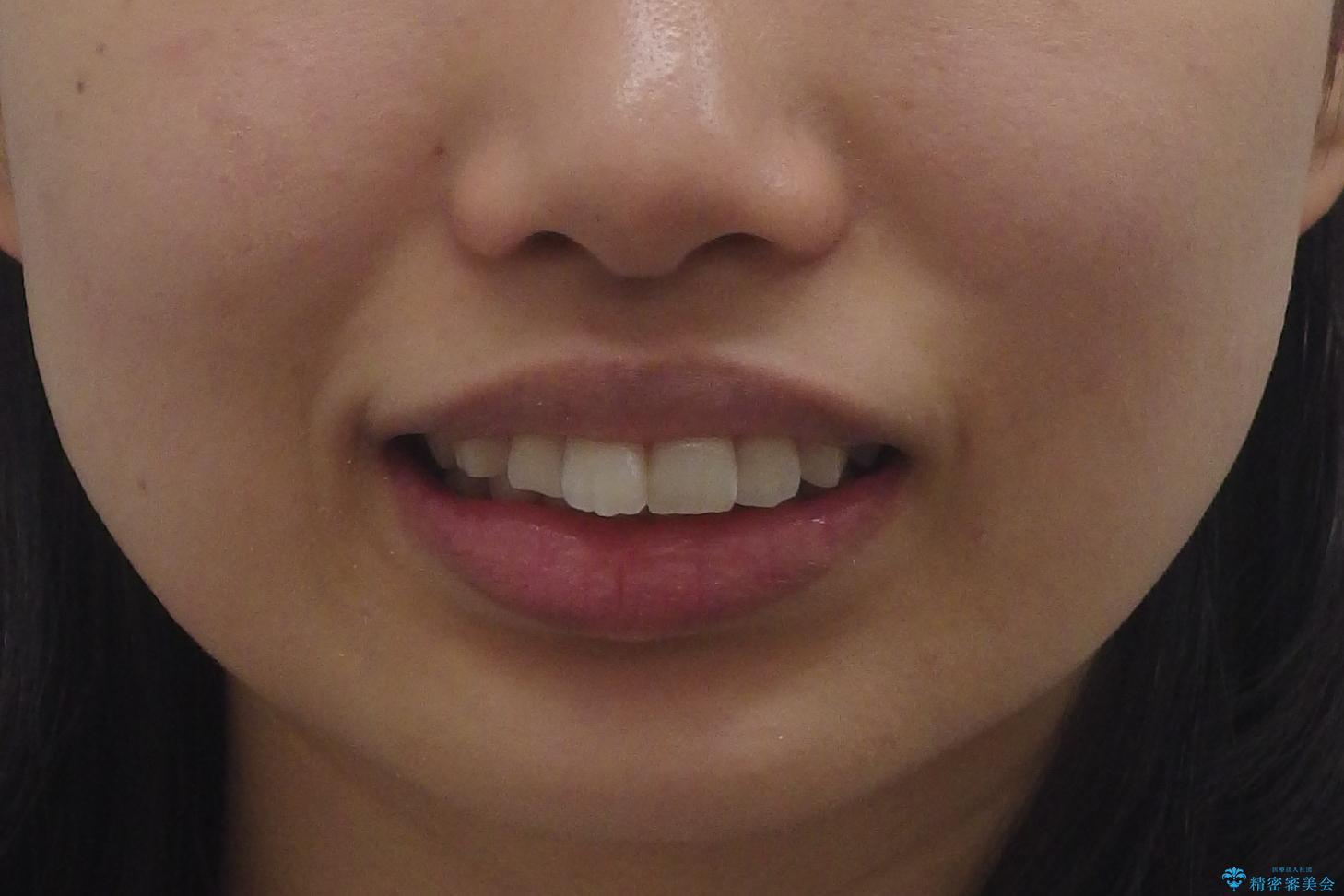 Eラインを整える治療 前歯を引っ込めますの治療前(顔貌)