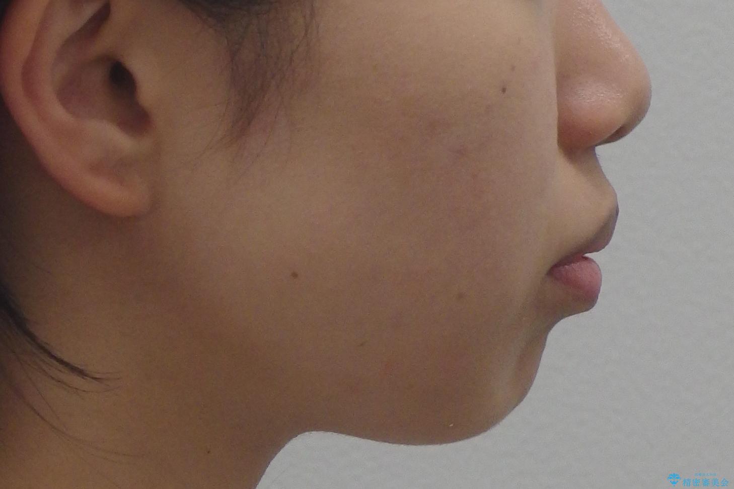 Eラインを整える治療 前歯を引っ込めますの治療前(顔貌)