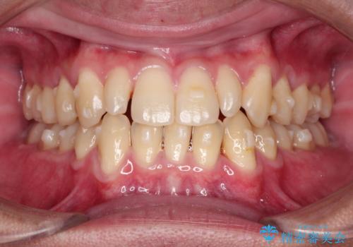 矮小歯(通常より小さな歯)をオールセラミックを装着して自然な歯への治療前