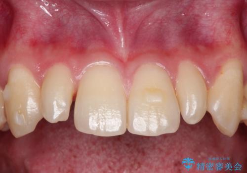 矮小歯(通常より小さな歯)をオールセラミックを装着して自然な歯への治療前