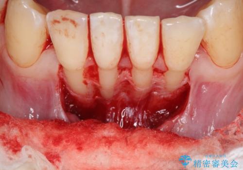 下顎前歯の歯肉退縮　結合組織を用いた根面被覆の治療前