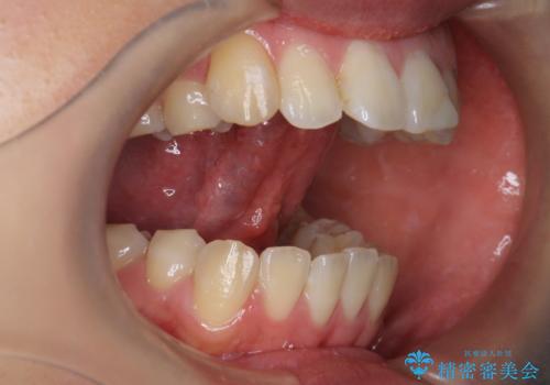 舌が持ち上がらない 舌小帯切除の治療後