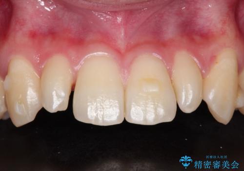 矮小歯(通常より小さな歯)をオールセラミックを装着して自然な歯への治療前