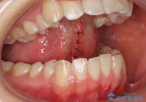 舌が持ち上がらない　舌小帯切除の治療中