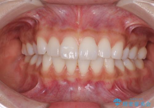 矯正治療の後戻り インビザラインによる再矯正治療の症例 治療前