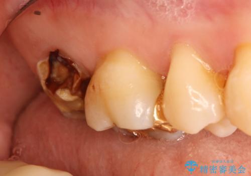 虫歯の治療 オールセラミッククラウンの治療前
