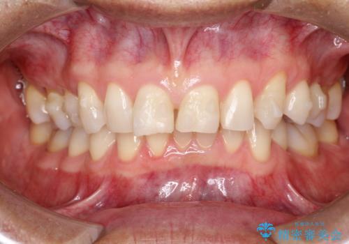 上の前歯の隙間とがたつきをインビザラインできれいな歯並びへの治療中