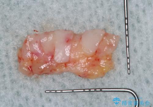 下顎前歯の歯肉退縮 結合組織を用いた根面被覆の治療中