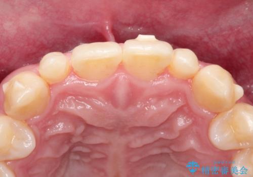 矮小歯(通常より小さな歯)をオールセラミックを装着して自然な歯への治療前