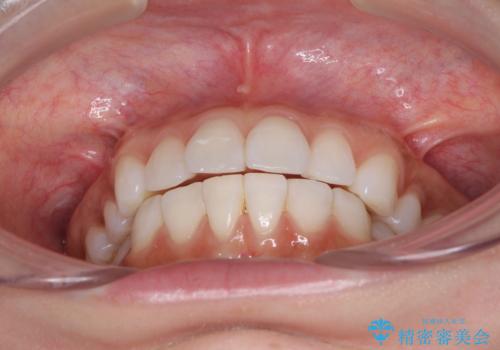 矯正治療の後戻り インビザラインによる再矯正治療の治療前