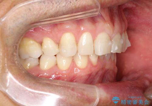 上の前歯の隙間とがたつきをインビザラインできれいな歯並びへの治療中
