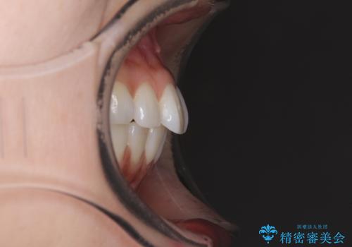 矯正治療の後戻り インビザラインによる再矯正治療の治療前