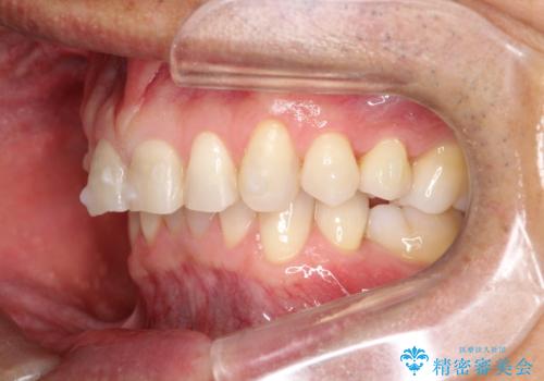 上の前歯の隙間とがたつきをインビザラインできれいな歯並びへの治療中