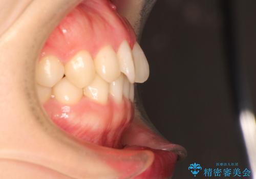 前歯のねじれをきれいにしたい　インビザラインによる見えない矯正治療の治療前