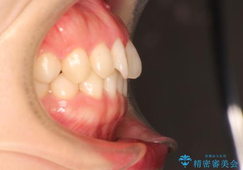 前歯のねじれをきれいにしたい インビザラインによる見えない矯正治療の治療前