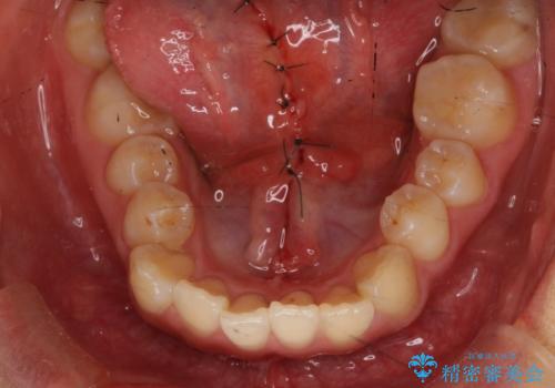 舌が持ち上がらない 舌小帯切除の治療中