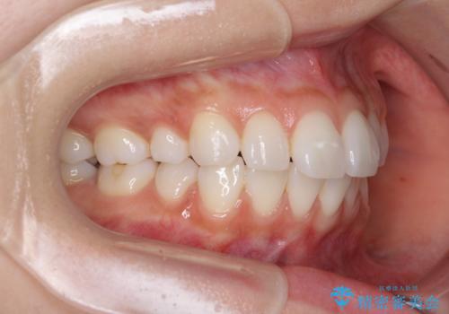 矯正治療の後戻り インビザラインによる再矯正治療の治療前