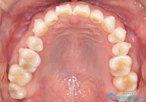上の前歯の隙間とがたつきをインビザラインできれいな歯並びへの治療中