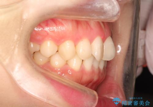 前歯のねじれをきれいにしたい　インビザラインによる見えない矯正治療の治療前