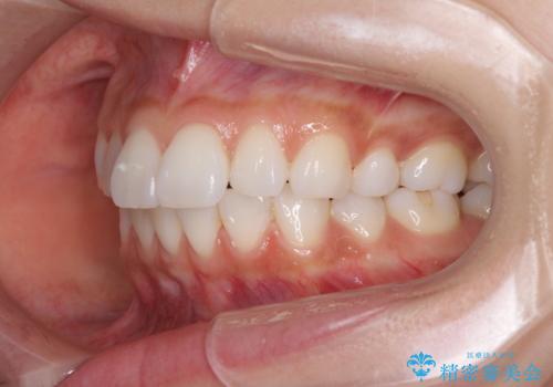 矯正治療の後戻り インビザラインによる再矯正治療の治療前