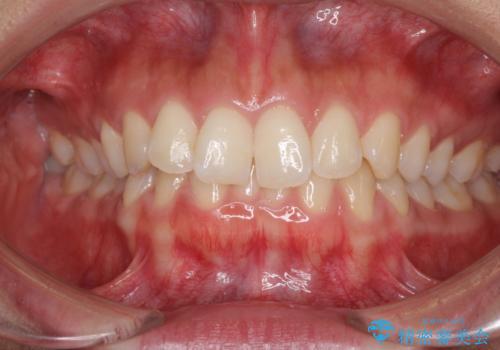 ディープバイトと前歯のデコボコを治したい インビザラインによる矯正治療の症例 治療前
