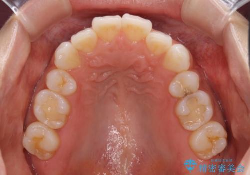 矯正治療の後戻り インビザラインによる再矯正治療の治療前