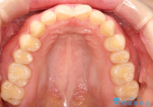 前歯のねじれをきれいにしたい　インビザラインによる見えない矯正治療の治療前