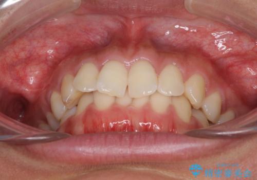 ディープバイトと前歯のデコボコを治したい インビザラインによる矯正治療の治療前