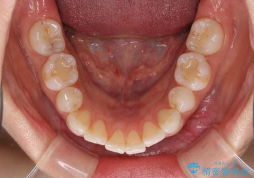 矯正治療の後戻り インビザラインによる再矯正治療の治療前