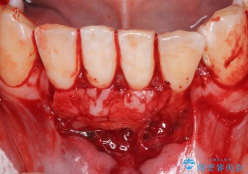 下顎前歯の歯肉退縮　結合組織を用いた根面被覆の治療後