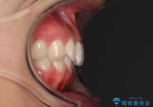 ディープバイトと前歯のデコボコを治したい インビザラインによる矯正治療の治療前