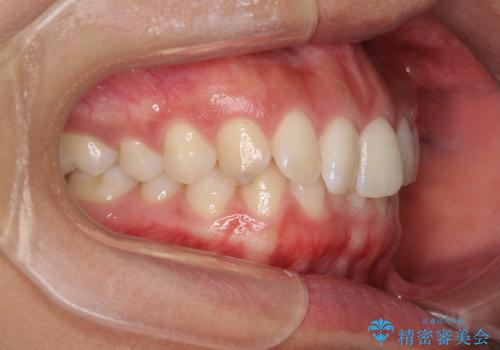 ディープバイトと前歯のデコボコを治したい インビザラインによる矯正治療の治療前