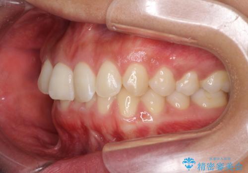 ディープバイトと前歯のデコボコを治したい インビザラインによる矯正治療の治療前