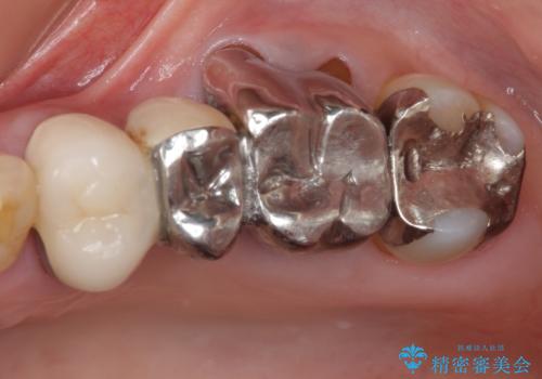 ものが挟まる　奥歯のセラミックブリッジ再製作の症例 治療前