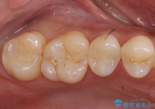 奥歯の虫歯 セラミックインレーにの治療後